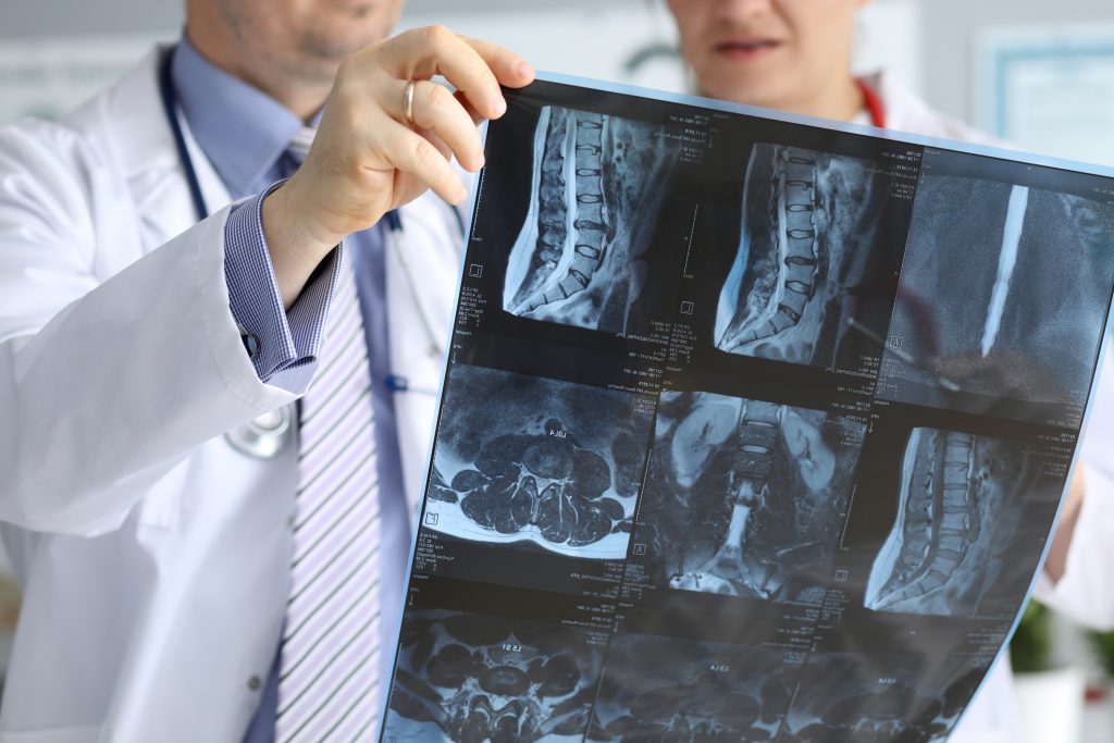 Los Angeles spinal cord injury lawyer