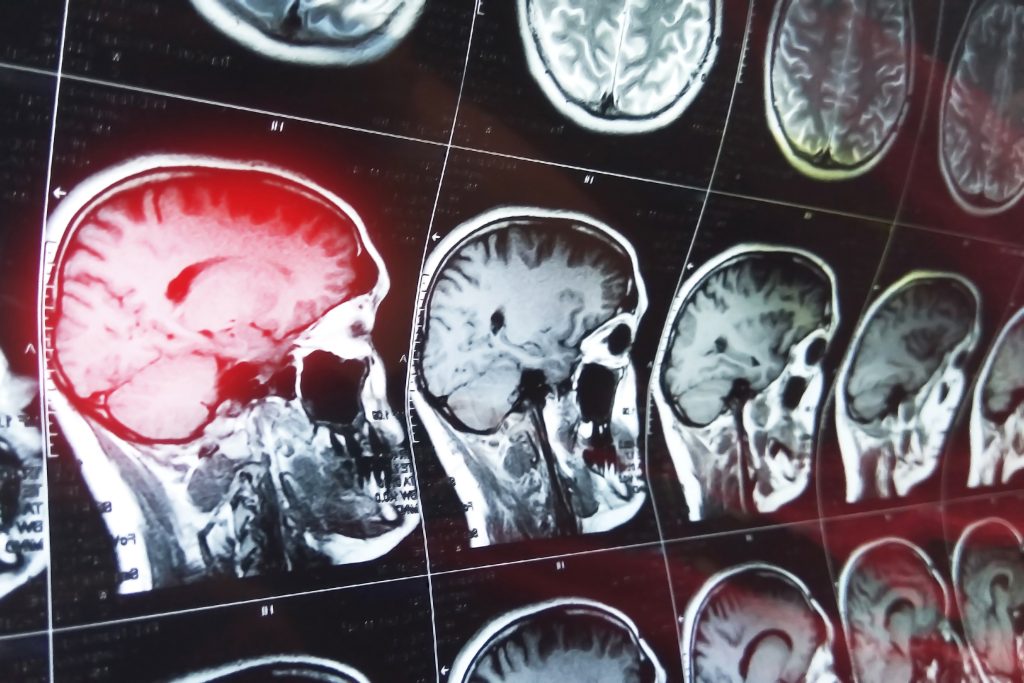 Los Angeles brain injury lawyer 